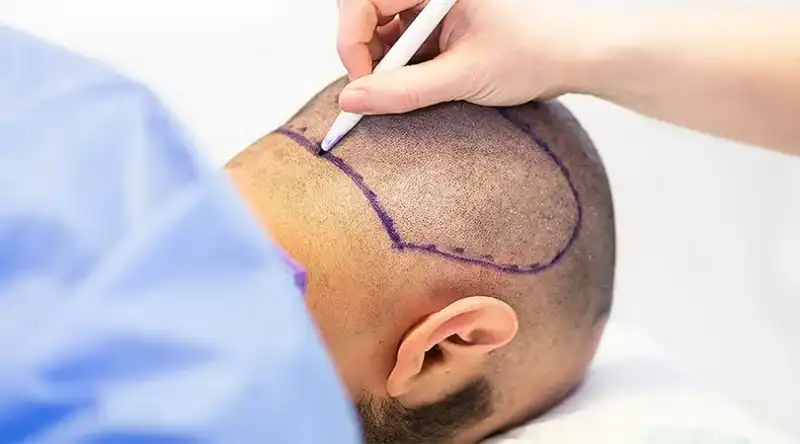 Things to consider before and after hair transplantation